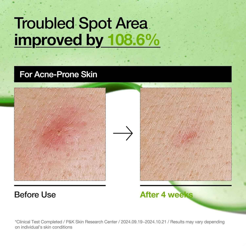 Azelaic Acid Hyaluron Redness Soothing Serum for Acne-Prone Skin