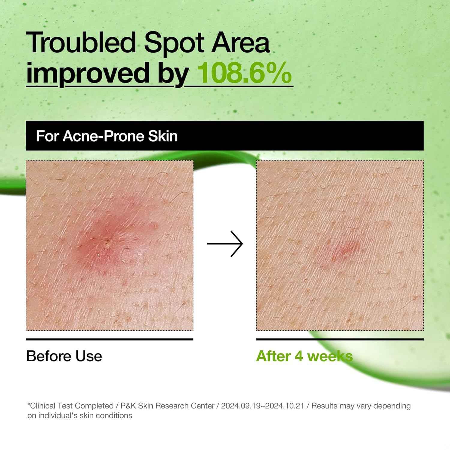 Azelaic Acid Hyaluron Redness Soothing Serum for Acne-Prone Skin